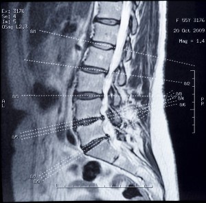 MRI of human spine