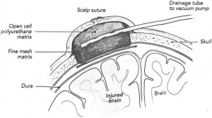Brain tissue vaccum treatment. Image: Wolters Kluwer Health